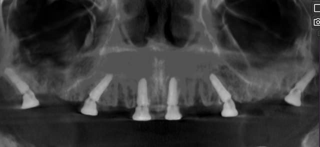 Implanturi maxilar