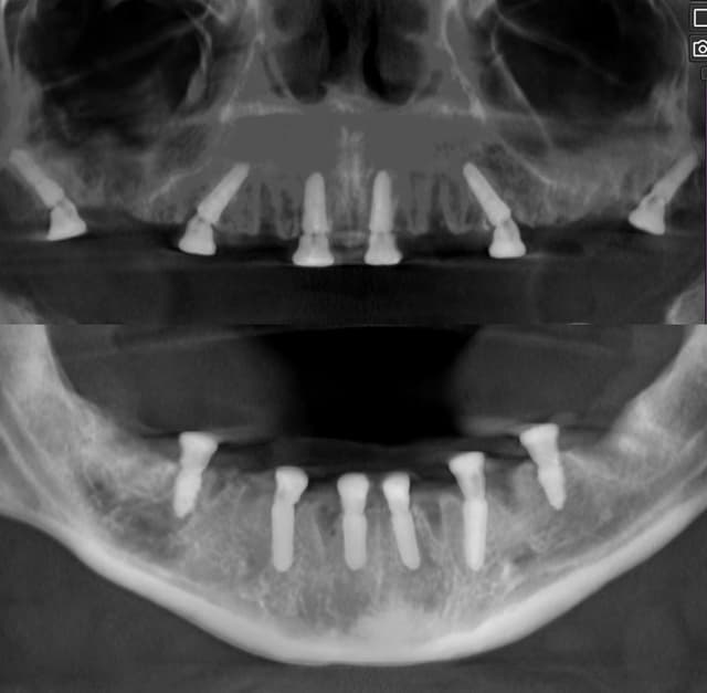 Rezultat final radiografie