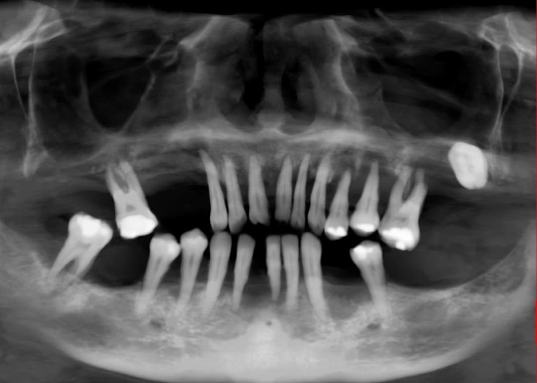 Caz 2 - radiografie inițială, dinți compromiși