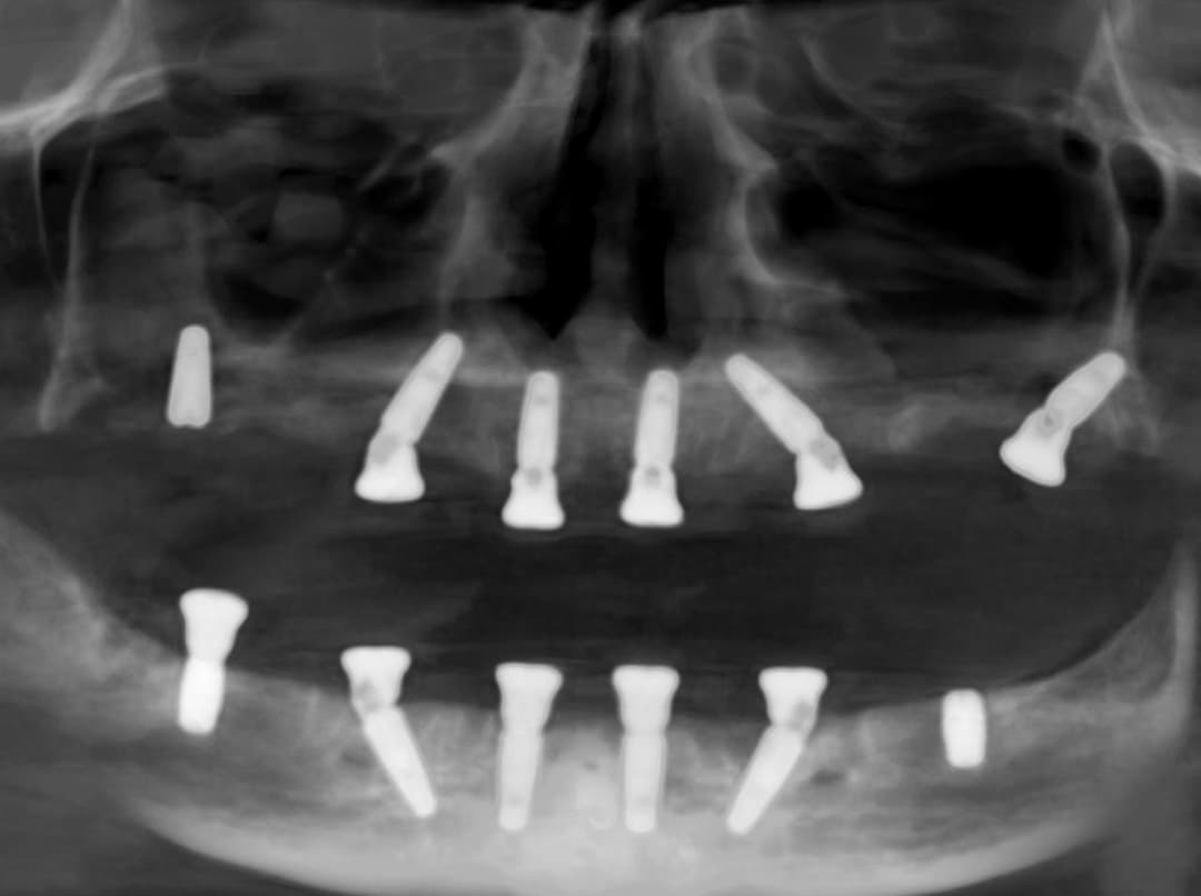 Caz 2 - radiografie după implantologie bilaterală
